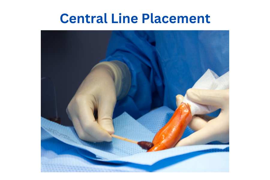 central line placement